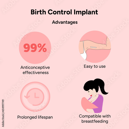 Birth control implant, advantages, medical illustration 
