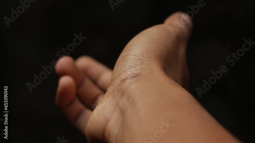Scar on the hand area with black background