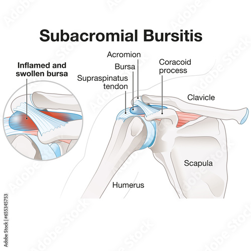 Subacromial bursitis of the shoulder. Medically Illustration. Labeled photo