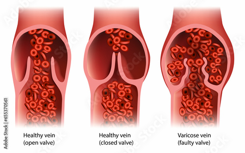 Chronic Venous Insufficiency or venous reflux.Venous Disease Varicose vein Faulty valve. Healthy vein photo