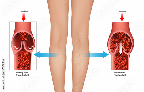 Venous Disease or Varicose vein and Faulty valve. Chronic Venous Insufficiency or venous reflux.