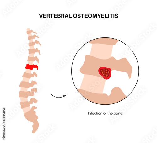 Vertebral osteomyelitis poster