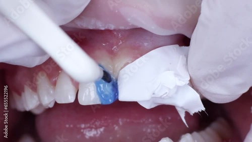 dentist apply acid itch blue gel on mesial aspect of central incisors teeth during diastema closure dental procedure, close up photo