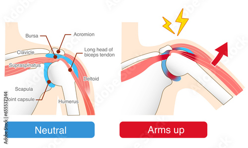 Impingement Syndrome. Causes and Mechanisms of Pain When Raising the Arm