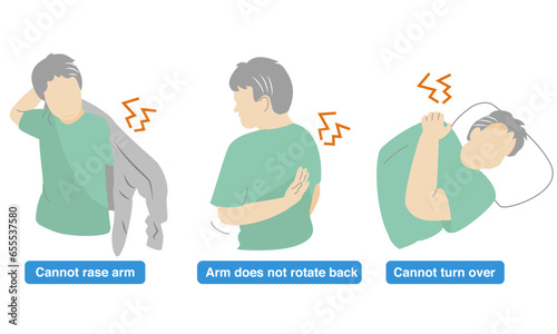 Illustration of a person with a sore shoulder and an arm that cannot lift.Impingement Syndrome