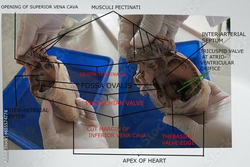 anatomical features of the interior of the right atrium photo