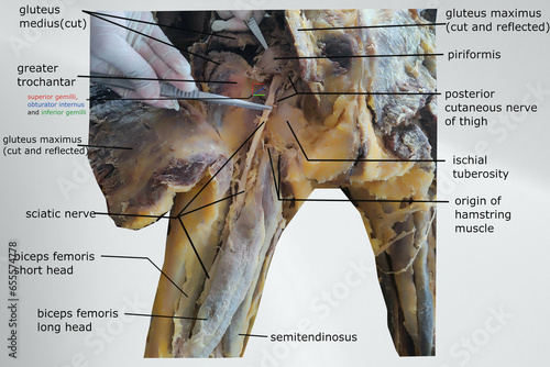 dissection picture of gluteal region showing sciatic nerve course and gluteal muscle photo
