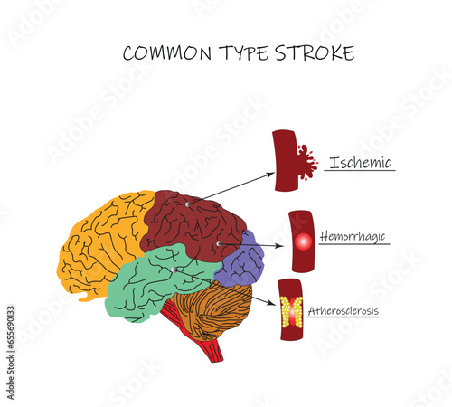 One common type of brain Stroke is characterized by brain tissue moving underneath the middle fold of the dura falx. This type is called a subalpine brain herniation