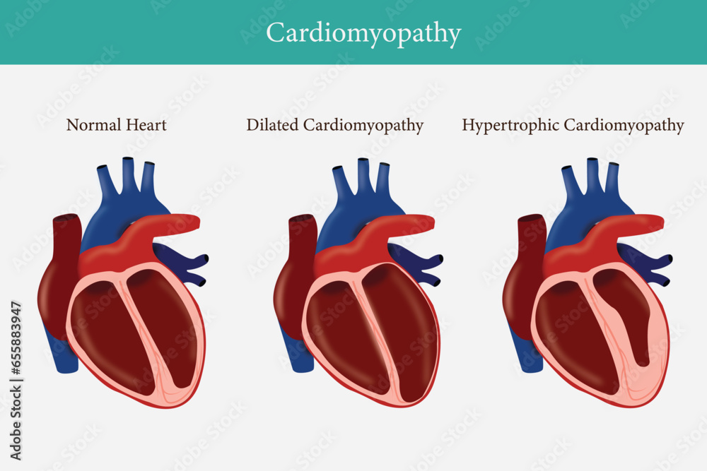 Types Of Heart Diseases Hypertrophic Cardiomyopathy And Dilated