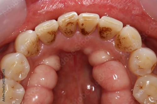 Canvastavla Torus mandibularis is a bony growth in the mandible along the surface nearest to the tongue
