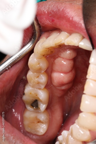 Torus mandibularis is a bony growth in the mandible along the surface nearest to the tongue. Mandibular tori are usually present near the premolars and above the location of the mylohyoid muscle.