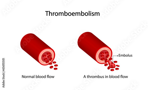 Thromboembolism. Circulating blood clot. Normal blood flow and a thrombus in blood flow, embolus. Red blood cells. Vector illustration.