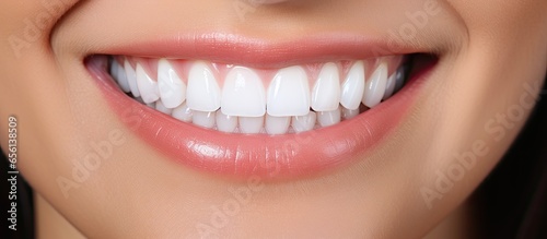 Enhance smile appearance through porcelain veneers
