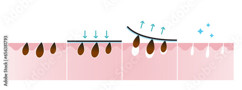 Blackhead removal process vector illustration isolated on white background. Cross section of  blackhead pore strip treatment, apply, peel off, unclogging and tighten pores. Before and after concept.