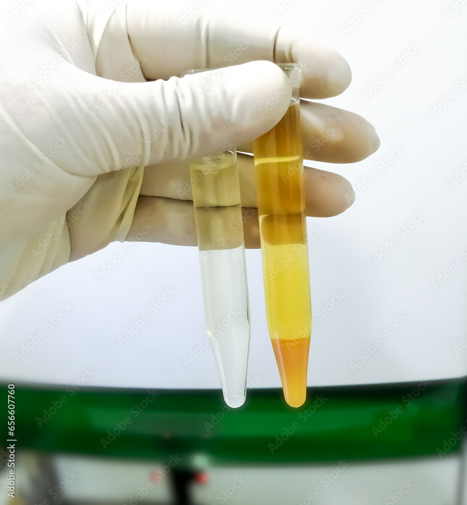 Lab Technologist hold 2 urine sample tube for analysis, one is normal