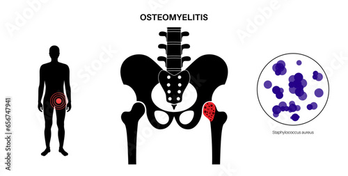 Osteomyelitis of hip