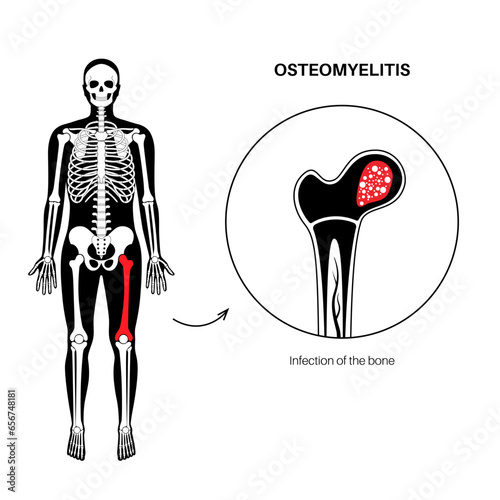 Osteomyelitis of hip photo