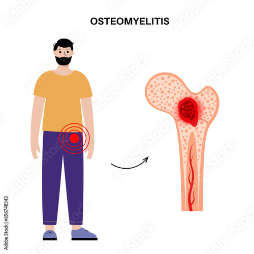 Osteomyelitis of hip