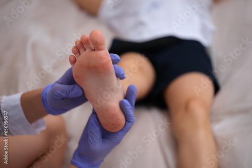 Infectious disease doctor examining rash on skin of child feet closeup. Coxsackie virus symptoms hand-foot-mouth concept photo