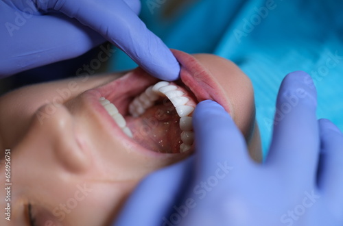 Doctor dentist examining patient oral cavity with veneers closeup. Installation of composite and zirconium veneers concept photo