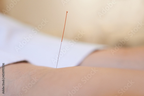 Acupuncture needle on chakra point on the back of the knee of a patient. Chinese traditional medicine for body healing