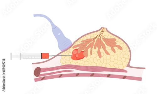 Breast cancer diagnostic biopsy for the specimen. Side view cross section of human female breast with mammary gland and unknown cyst in fat tissue.