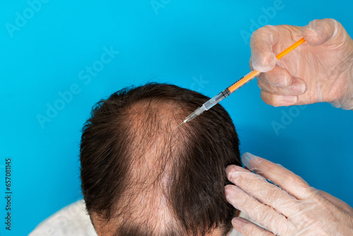 A doctor with a syringe in gloves making an injection to a man with alopecia on a blue background close-up.