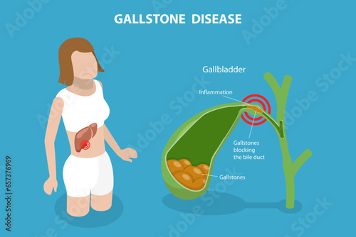 3D Isometric Flat Vector Conceptual Illustration of Gallstone Disease, Formations in the Gallbladder photo