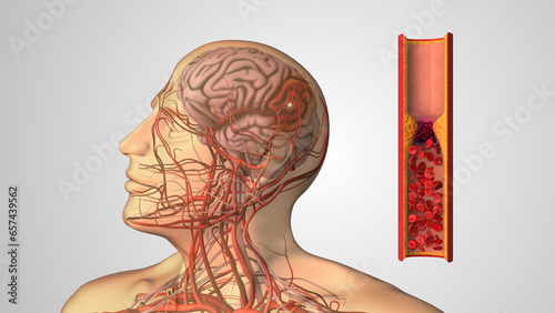 Medical concept of atherosclerotic cardiovascular disease and stroke photo