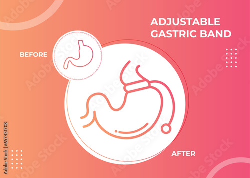 Illustration of Adjustable Gastric Band devise Weight Loss Surgery vector
