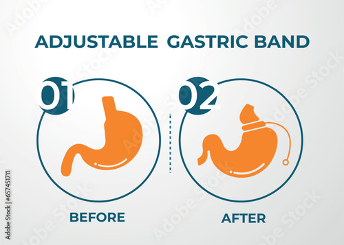 Illustration of Adjustable Gastric Band devise Weight Loss Surgery vector
