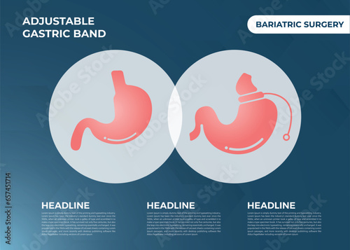 Illustration of Adjustable Gastric Band devise Weight Loss Surgery vector
