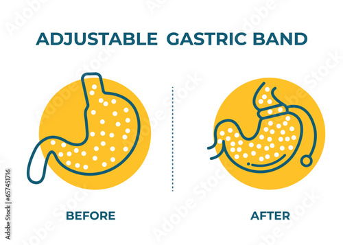 Illustration of Adjustable Gastric Band devise Weight Loss Surgery vector
