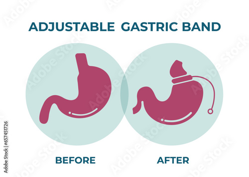 Illustration of Adjustable Gastric Band devise Weight Loss Surgery vector

