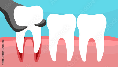 tooth extraction, A vector stock illustration photo