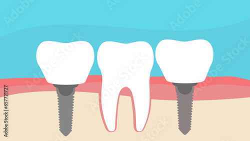 dental implant, A vector flat stock illustration