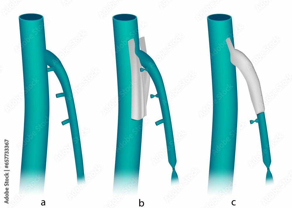 External valvuloplasty banding of the saphenofemoral junction in insufficient great saphenous veins. Venous Insufficiency Treatment Venoablation. External valvuloplasty banding of the saphenofemoral junction in insufficient great saphenous veins. Venous Insufficiency Treatment Venoablation.