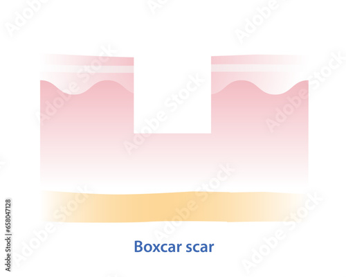 Cross section of boxcar scar vector illustration isolated on white background. Boxcar scar, atrophic scar, type of acne scar on skin surface. Skin care and beauty concept.
