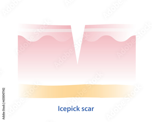 Cross section of icepick scar vector illustration isolated on white background. Icepick scar, atrophic scar, type of acne scar on skin surface. Skin care and beauty concept.