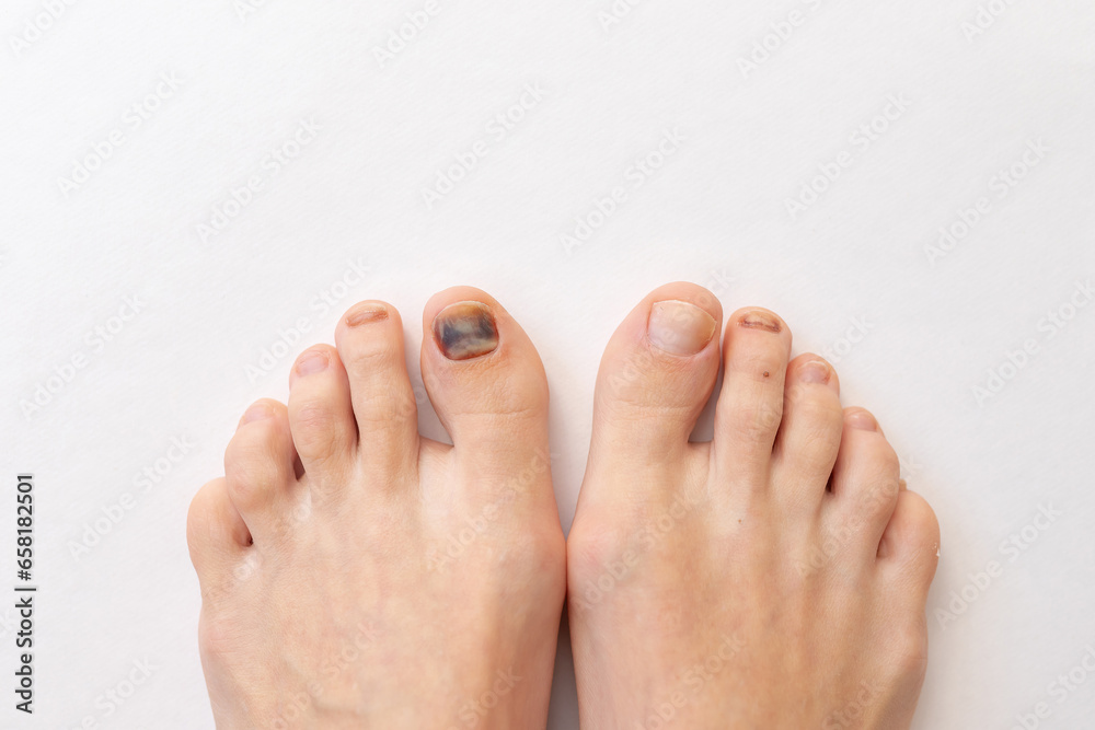 Subungual hematoma present under the toenail of the hallux, more