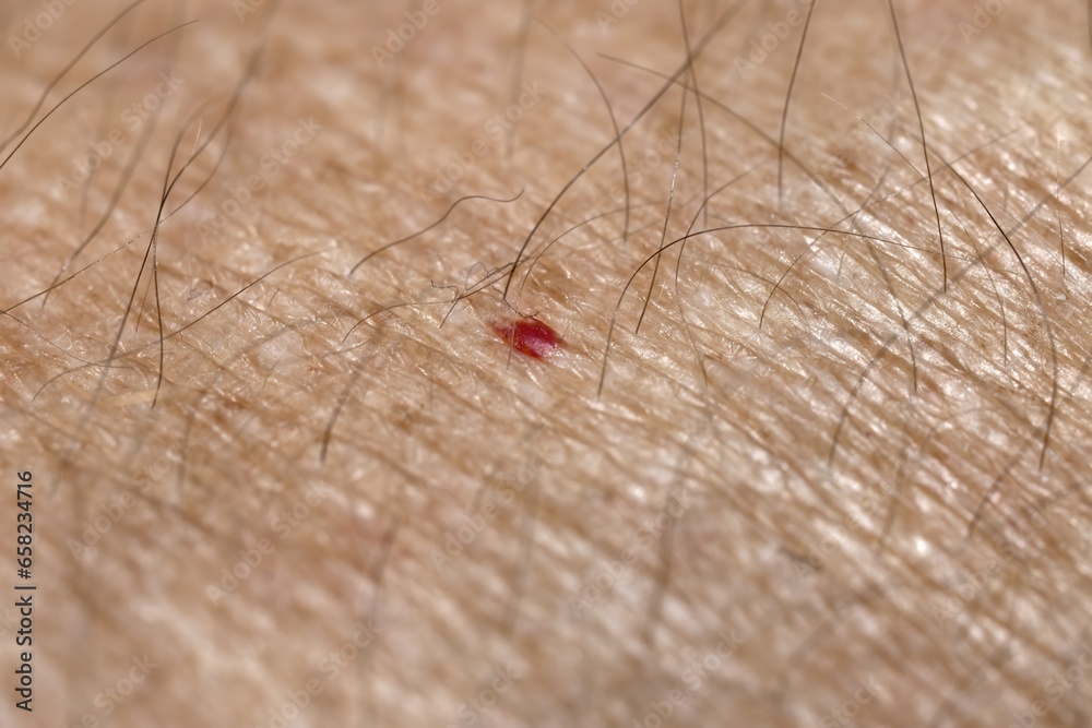 Red moles, also known as ruby dots or blood moles, appear on the skin