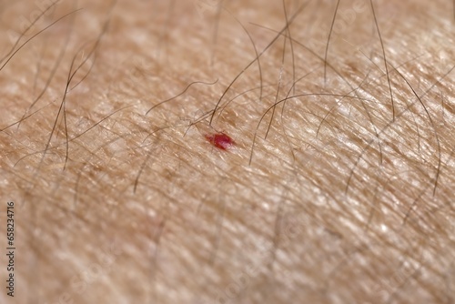 Red moles, also known as ruby dots or blood moles, appear on the skin in areas such as the arms, neck, or chest. They are mainly due to the dilation of blood capillaries