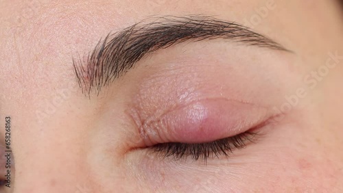 Close up female patient's infected eye. The brown-eyed woman staring at the camera has an external stye bacterial infection. Hordeolum on upper eyelid. Viral Infection. Staphylococcus. Ophthalmology photo