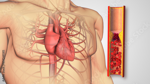Atherosclerosis disease or Human heart with blocked arteries