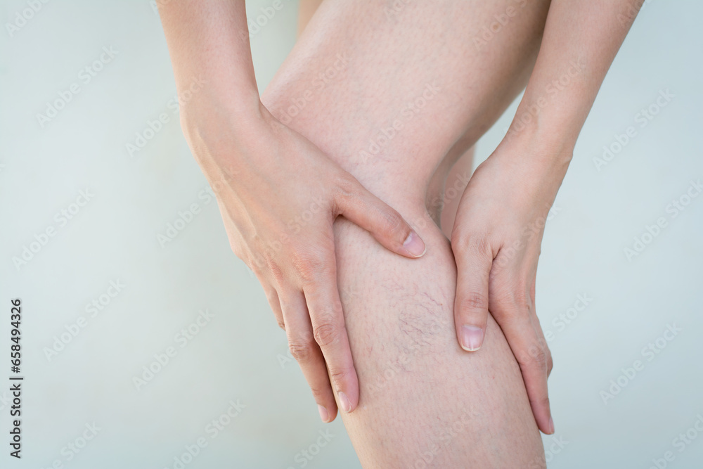 Varicose veins on the skin of leg