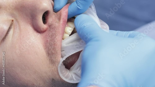 Man dentist in gloves takes an intraoral lip and cheek retractor in into patients mouth. Male patient wearing dental gag lying in dentists chair. Disposable rubber mouth opener photo