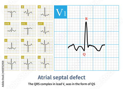 Male, 13 years old, clinically diagnosed with secundum atrial septal defect. Note that the QRS wave in lead V1 of the electrocardiogram has a qR shape, indicating right ventricular hypertrophy. photo