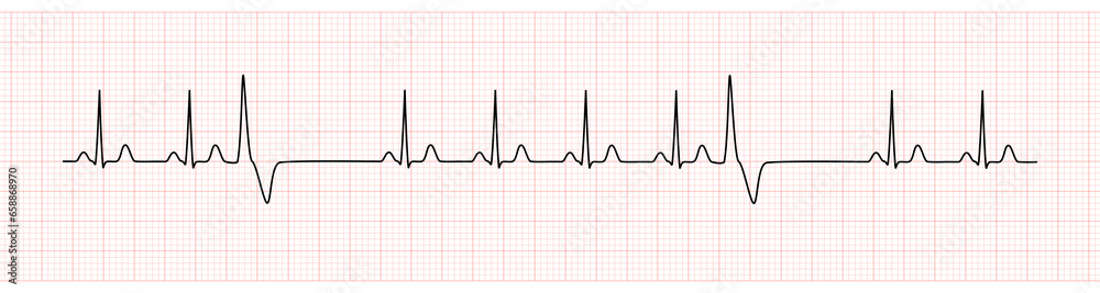 EKG Monitor Showing  Sinus Rhythm with PVC - obrazy, fototapety, plakaty 