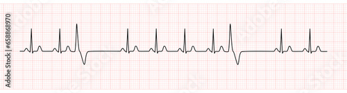 EKG Monitor Showing  Sinus Rhythm with PVC photo