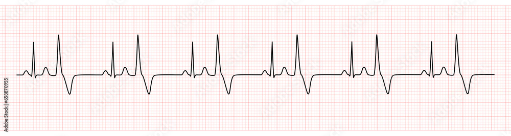 EKG Monitor Showing  Sinus Rhythm with Bigeminy PVC